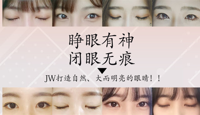  韩国双眼皮手术最好医院l韩国JW整形医院