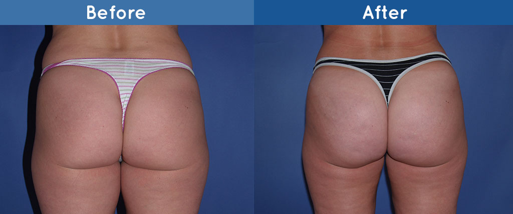 Buttock Augmentation before and after