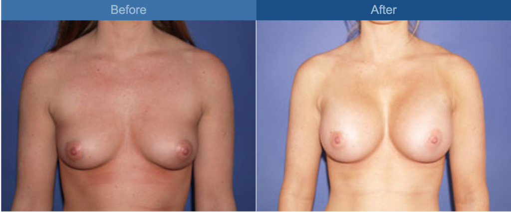 breast procedure