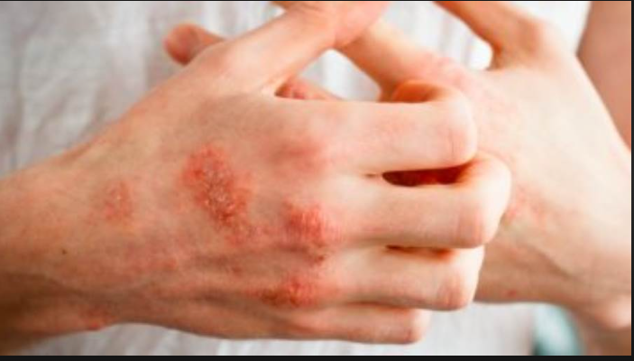 خبراء الأمراض الجلدية ينصحونك بالتخلص من السليوليت بطرق بسيطة بالمنزل