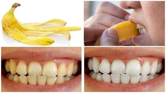 وصفات طبيعية لتبييض الأسنان والتخلص من اللون الأصفر 