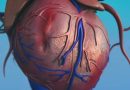 Hypothesis on recipients heart transplant