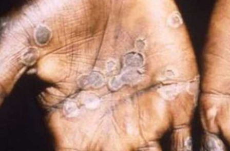 Dominican Republic confirms its first case of monkeypox