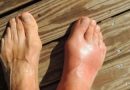 People with gout?