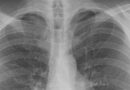 Black lung disease