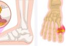 5 factors that increase the risk of gout