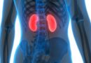 Who is at high risk for kidney stones?