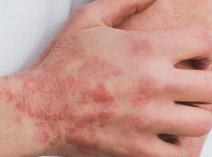 What you need to know about psoriasis