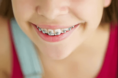 clean your teeth while wearing braces