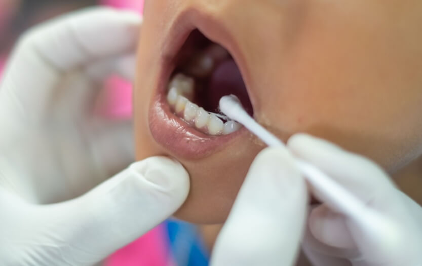 Understanding Fluoride Treatment: Guide to Dental Care