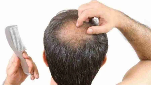 Cara Mengatasi Rambut Rontok Secara Alami 