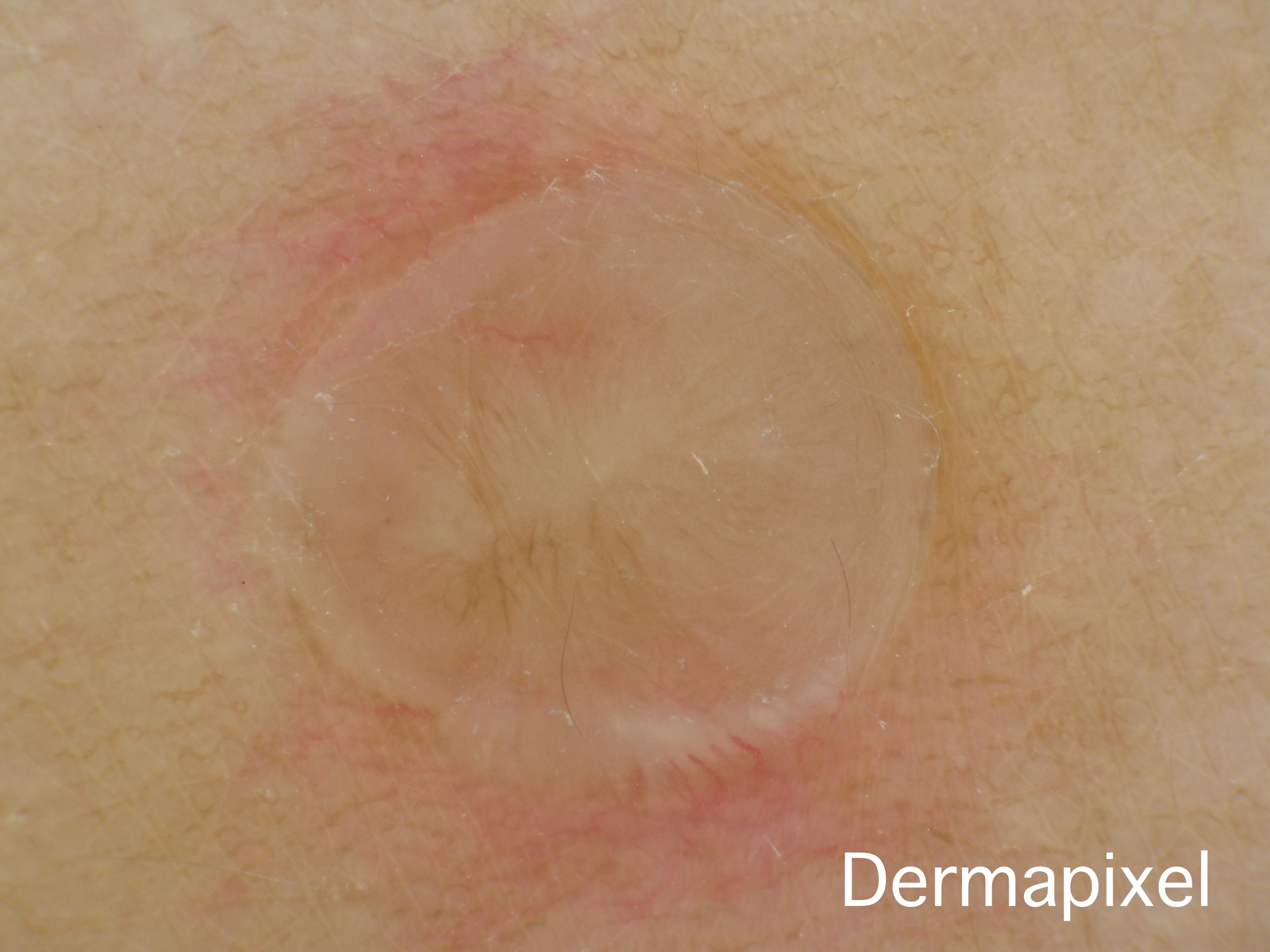 Dermapixel Fibroma Esclerotico Si Esta Solito No Pasa Nada
