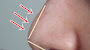 Signs Of Necrosis After Rhinoplasty