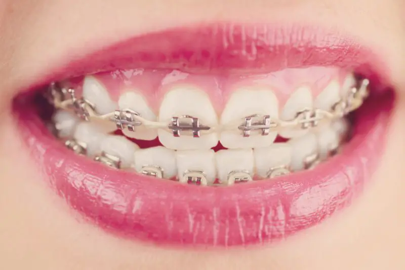 Are Power Chains The Last Step In Braces?