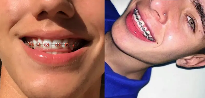 Best Braces Colors For Guys Best Braces Colors For Light Skin Red and Black