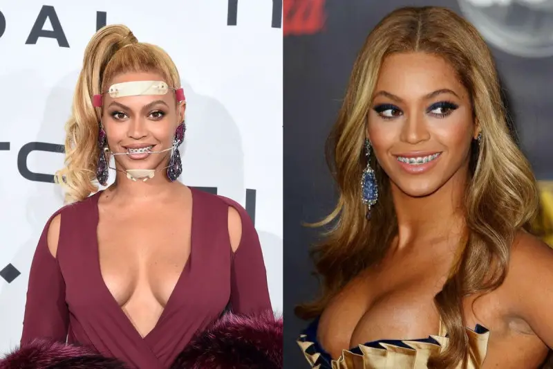 Did Beyonce Have Braces - Beyonce With Braces FAKE