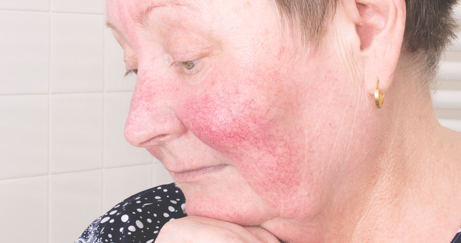 woman with rosacea in her cheeks