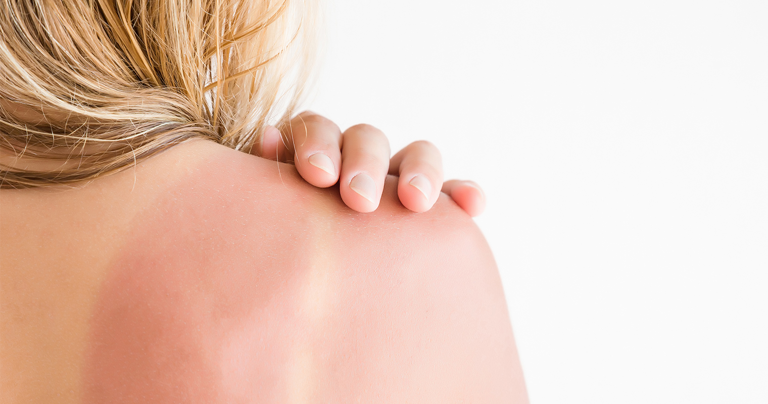girl's shoulder with sun burnt