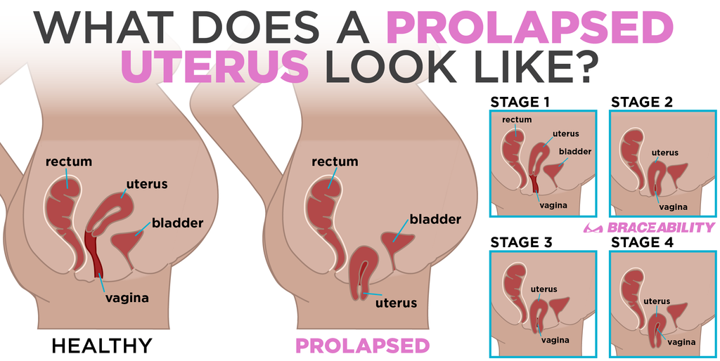 Prolapse Pelvic Support Belt Gave Me Confidence To Get Back To Life