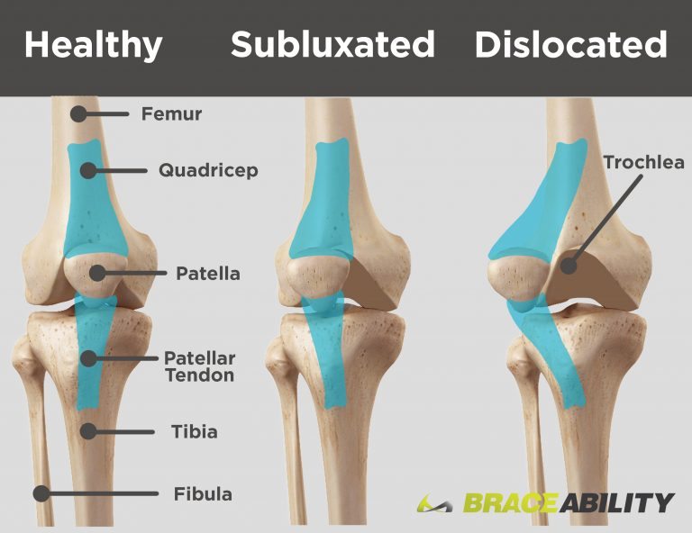 Kneecap Instability Medial Vs Lateral Patellar Dislocation