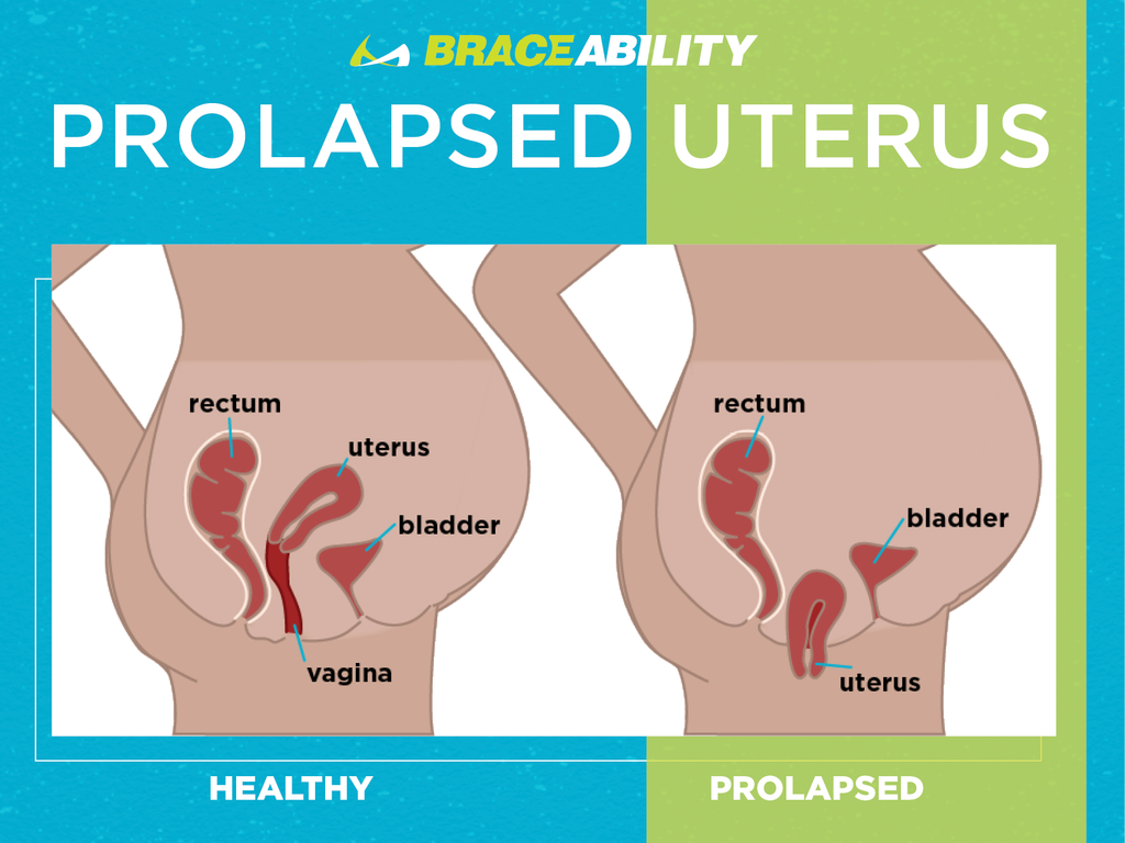 The 1 Guide To Pelvic Uterine Prolapse What Is A Prolapsed Uterus