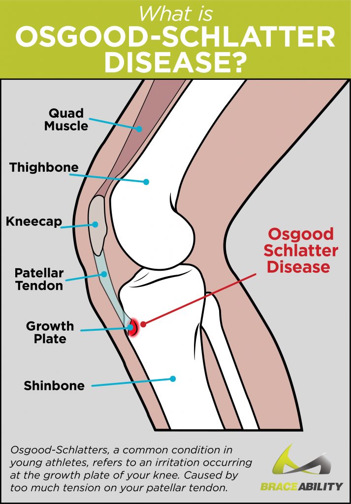 Osgood Schlatter Disease In Adults Treatment For Knee Pain