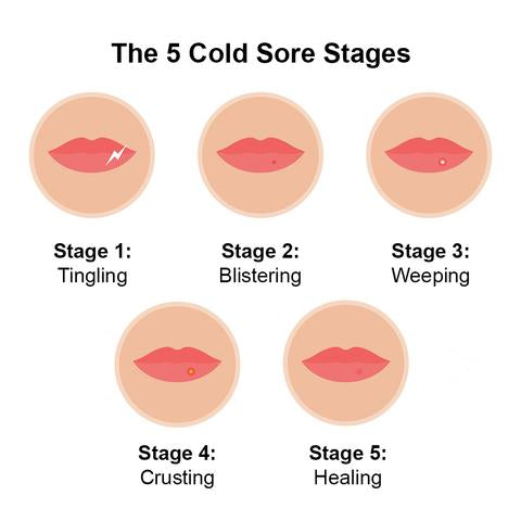 The 5 Cold Sore Stages A Step By Step Guide Luminance Red