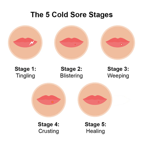 The 5 Cold Sore Stages A Step By Step Guide Luminance Red