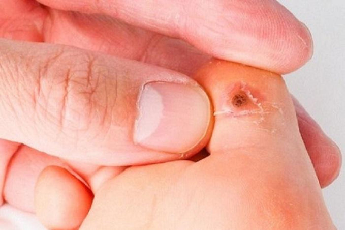 Papiloma En El Pie En Ninos Contagio Y Tratamiento Scholl Es