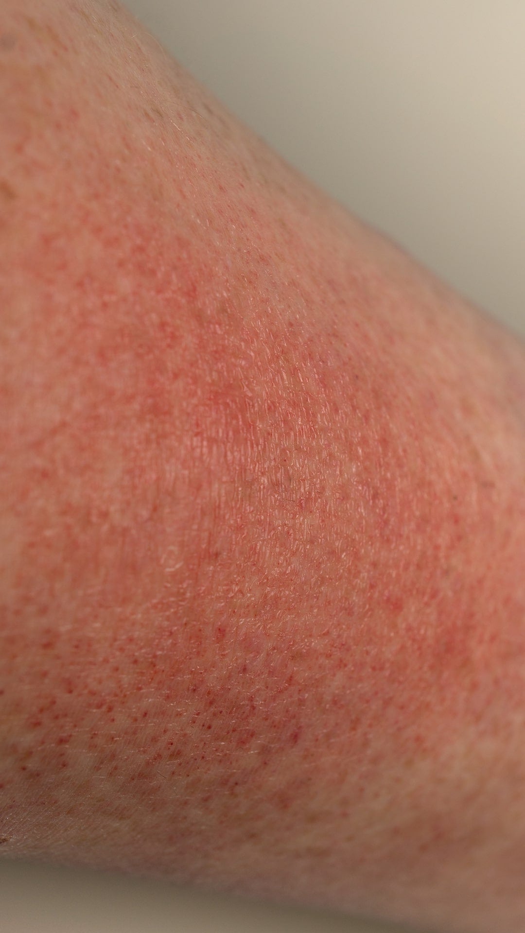 How To Treat Heat Rash Naturally