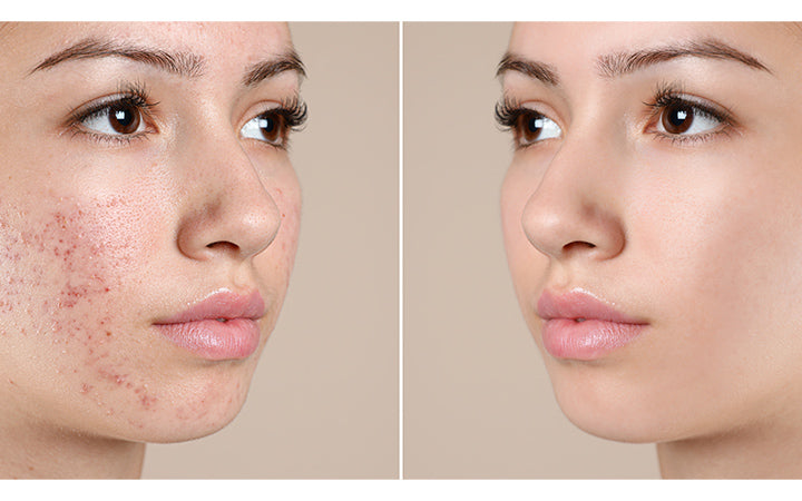 How Does Coconut Oil Treat Acne Best Way To Use It Vedix