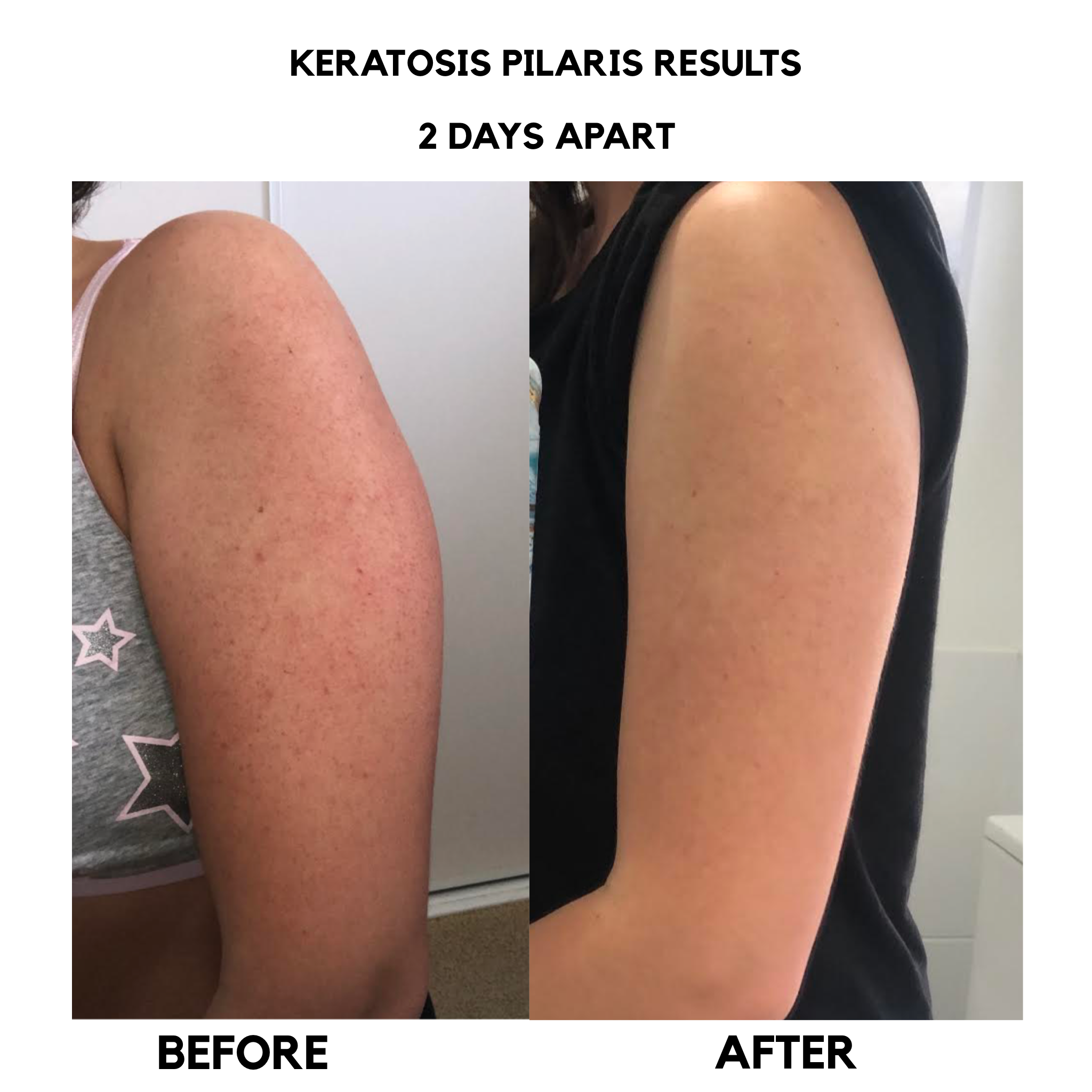 keratosis pilaris treatment