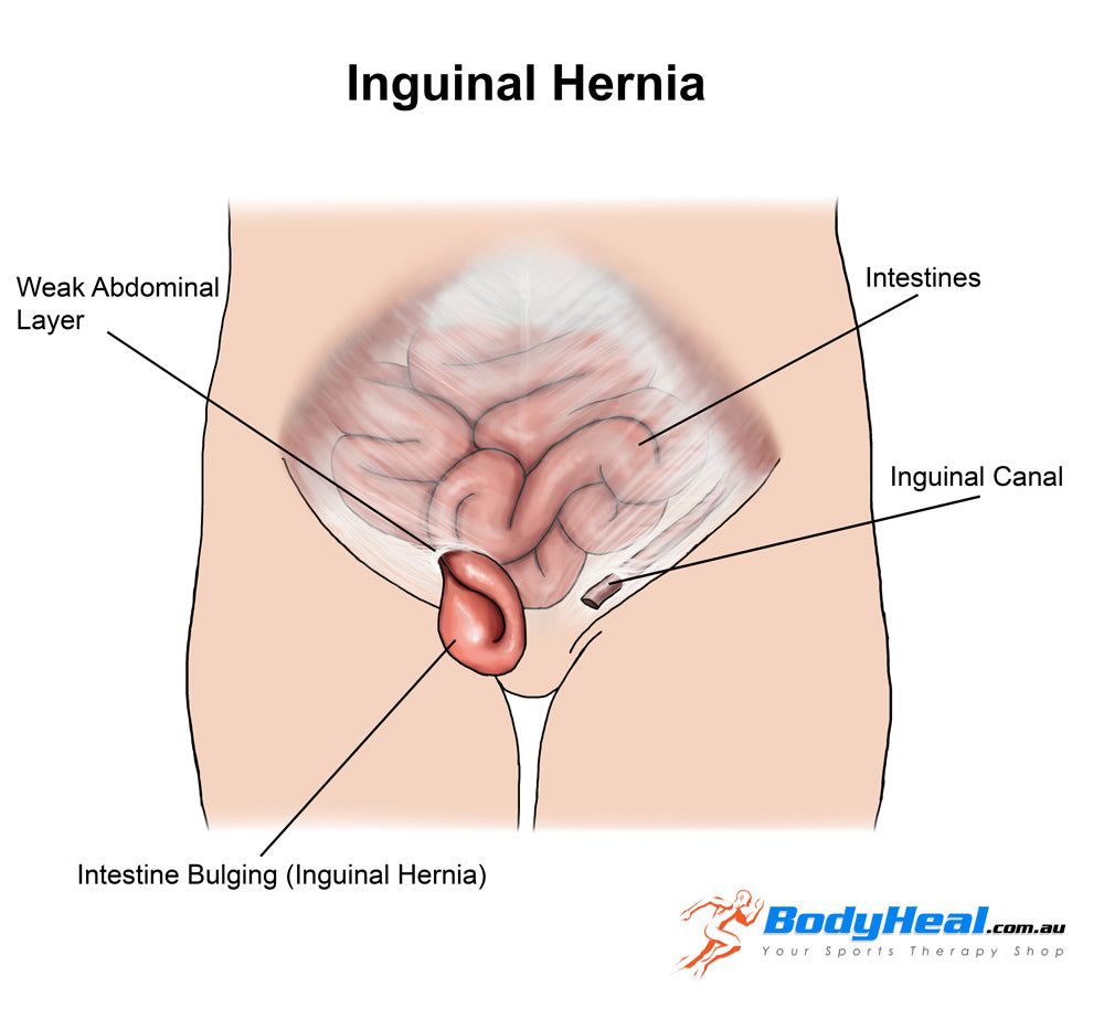 What Is Inguinal Hernia Causes Symptoms Treatment Options