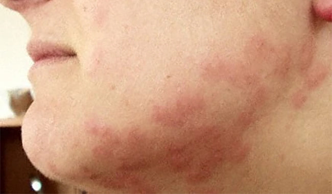 Boutons Et Piqures De Punaise De Lit Photos Allopunaise