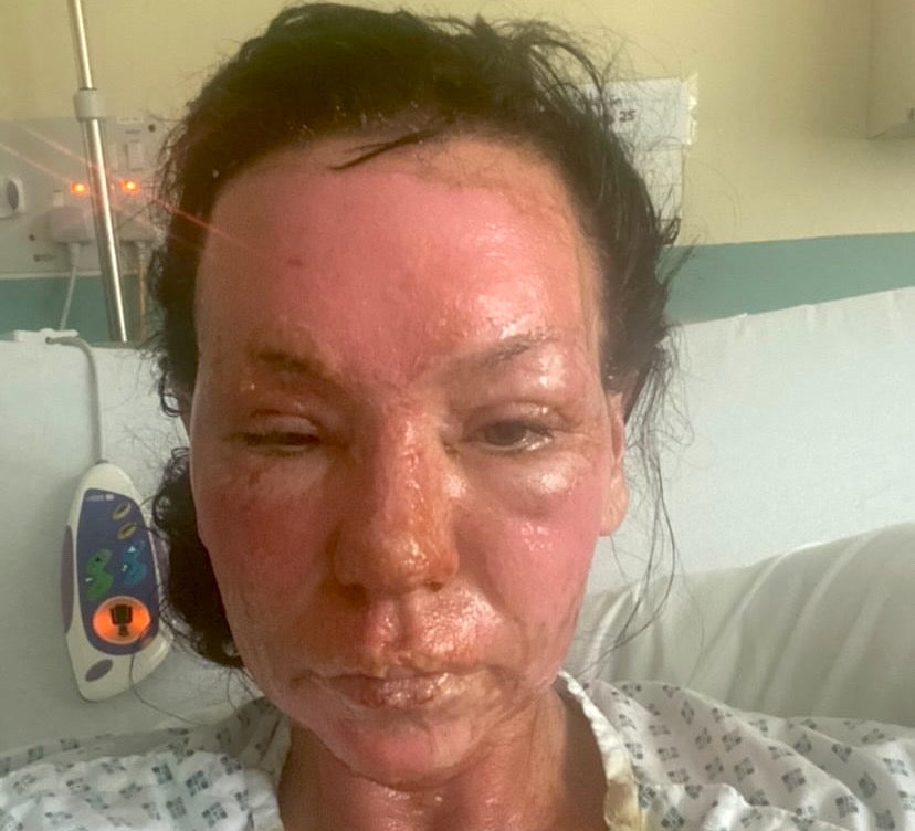 Second Degree Skin Burn Treatment Kylies Story Hanna Sillitoe