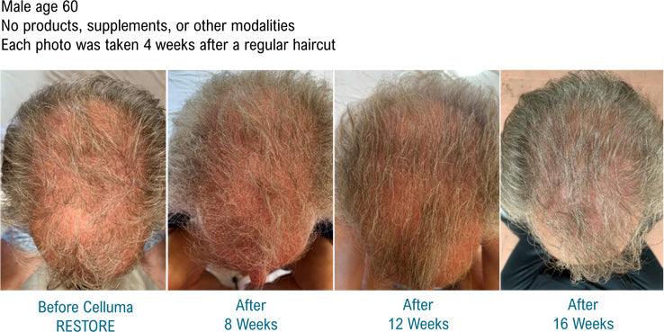 Best Red Light Therapy Device For Hair Loss Hair Growth Celluma