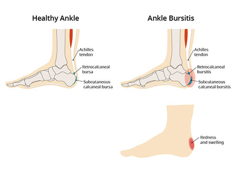 How To Fix Insertional Achilles Tendonitis