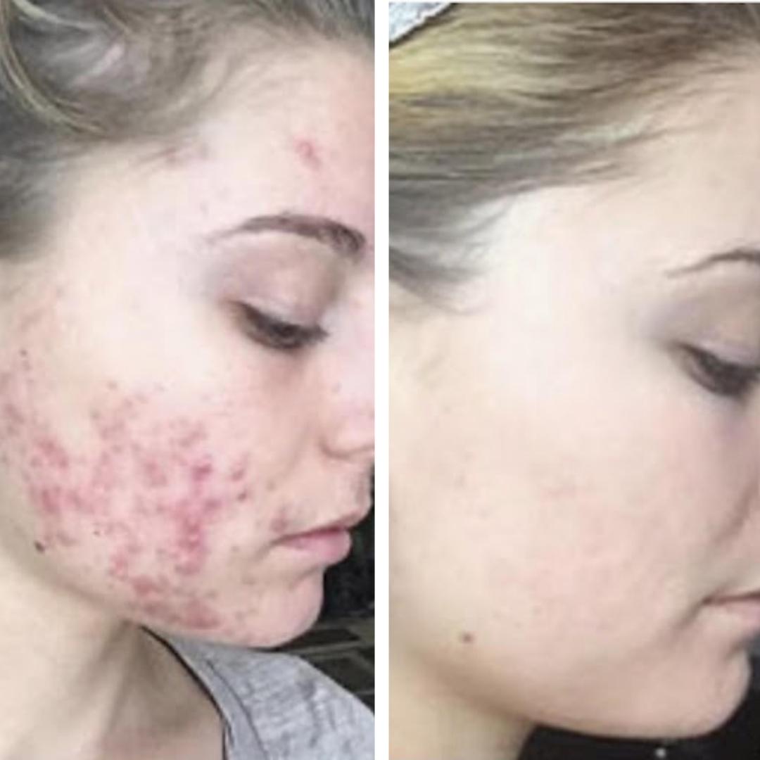 Acne Eraser Acne Treatment Benzoyl Peroxide Emme Diane