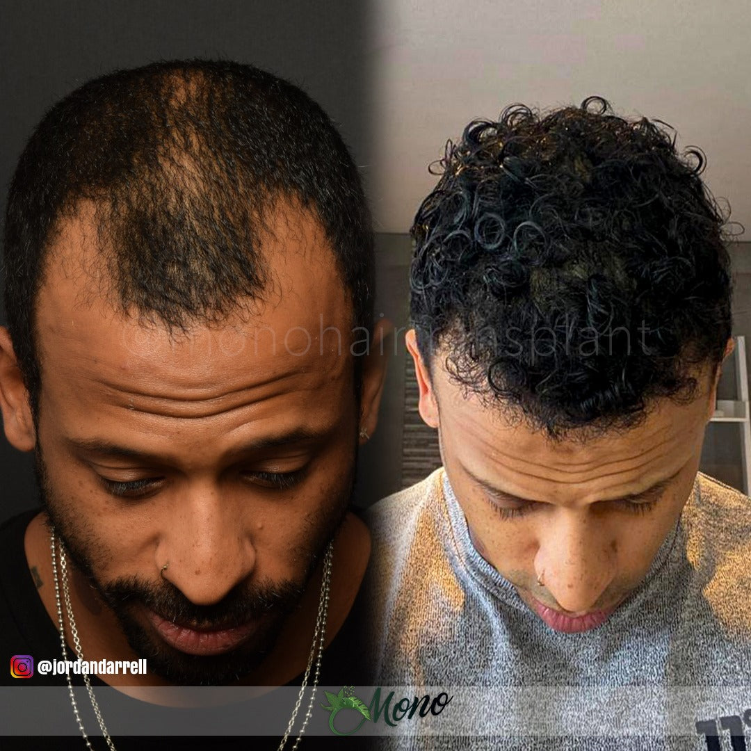 Stop Hair Loss Fue Hair Transplant Turkey Lifestyle By Ps