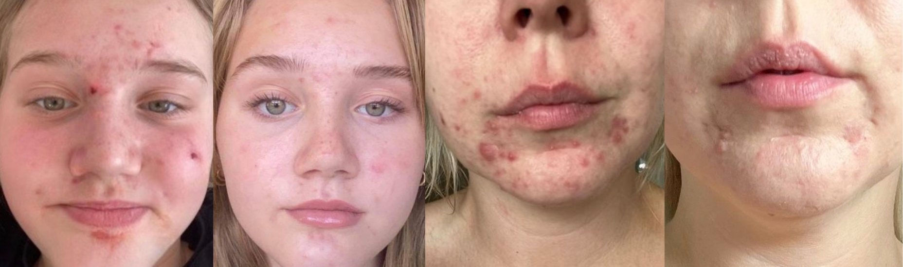 Uren Og Olieret Hud Hemphilia