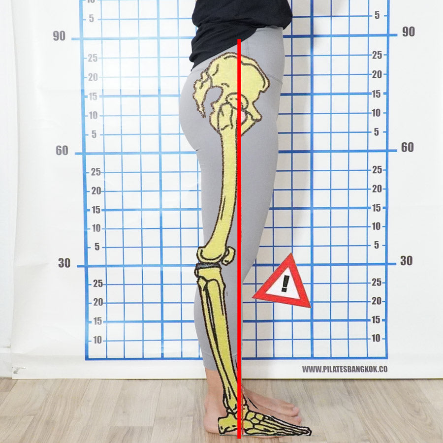 Knock Knees Exercises Treatment Bangkok Sanooklife