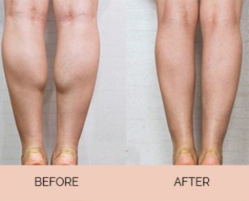 Easy Calf Reduction Methods For Beautiful Legs Jivaka Beauty Jivaka Beauty