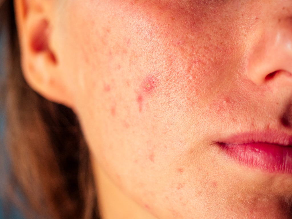 Can Acne Rosacea Go Away On Its Own Balmonds
