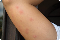 Bed Bug Bites Up Close Bed Bug Sos