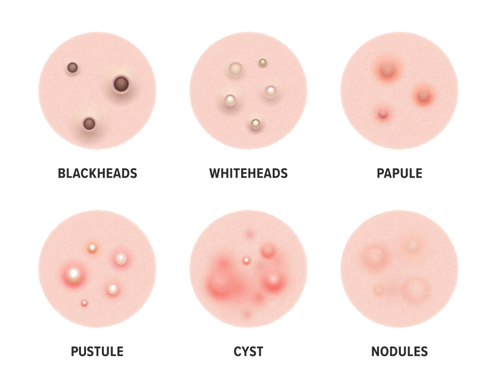Die Top 10 Pickel Ausloser Wie Du Sie Los Wirst Skincare Patches With Microneedling Technology For Acne Pimples Under Eye Bags And Shadows And Wrinkles