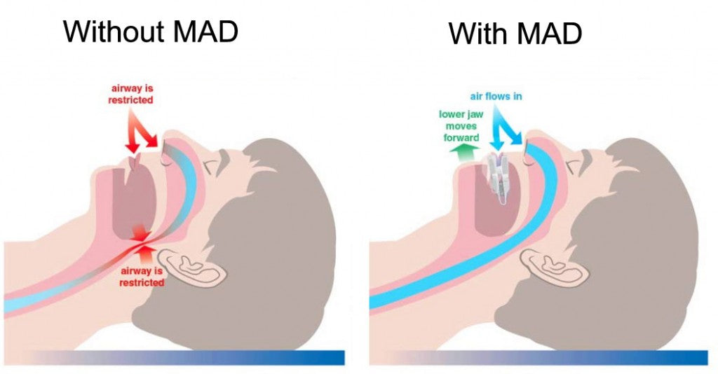 How Mandibular Advancement Devices Work Cpap Victoria