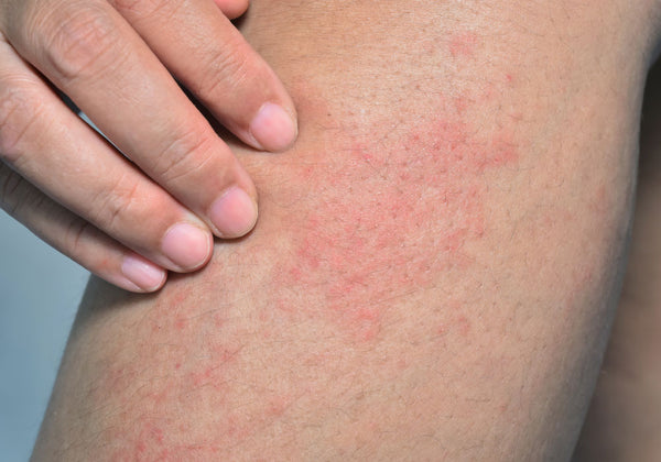 10 Common Rashes In Children Lloydspharmacy