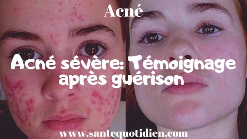 Acne Severe Temoignage Apres Guerison Sante Quotidien