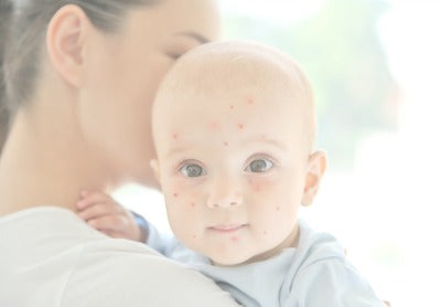 Baby Chicken Pox The Complete Guide For Parents