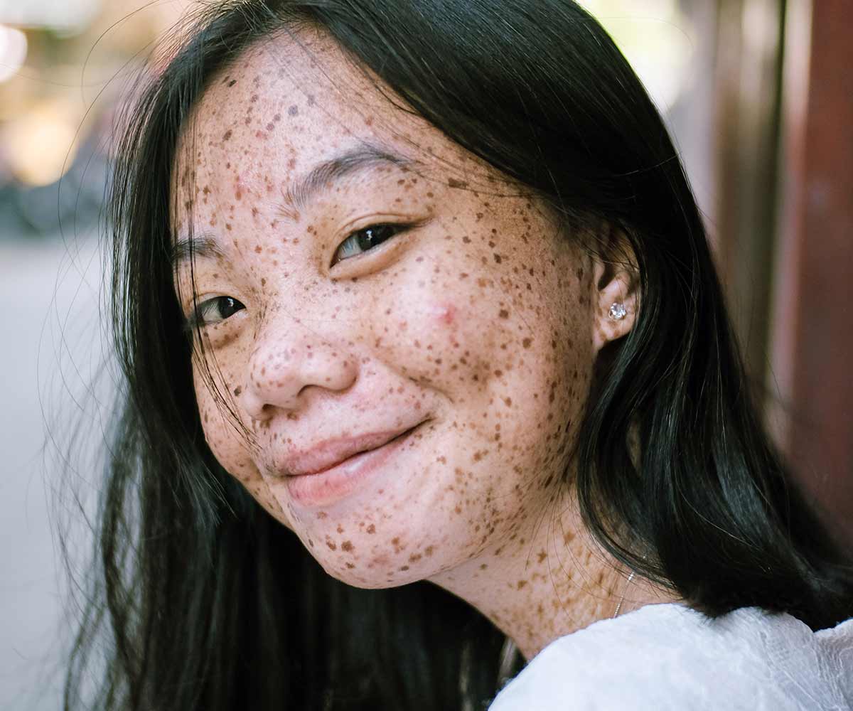 Boutons D Acne Nos Remedes Efficaces Pour Les Enlever Kadalys